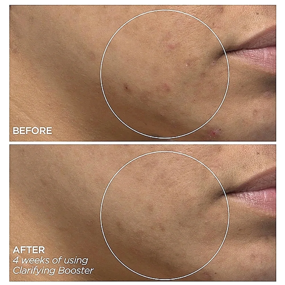 NEW BeautyBio Salicylic Acid Clarifying Booster Serum Acne Spot Treatment 1oz. - Picture 5 of 7